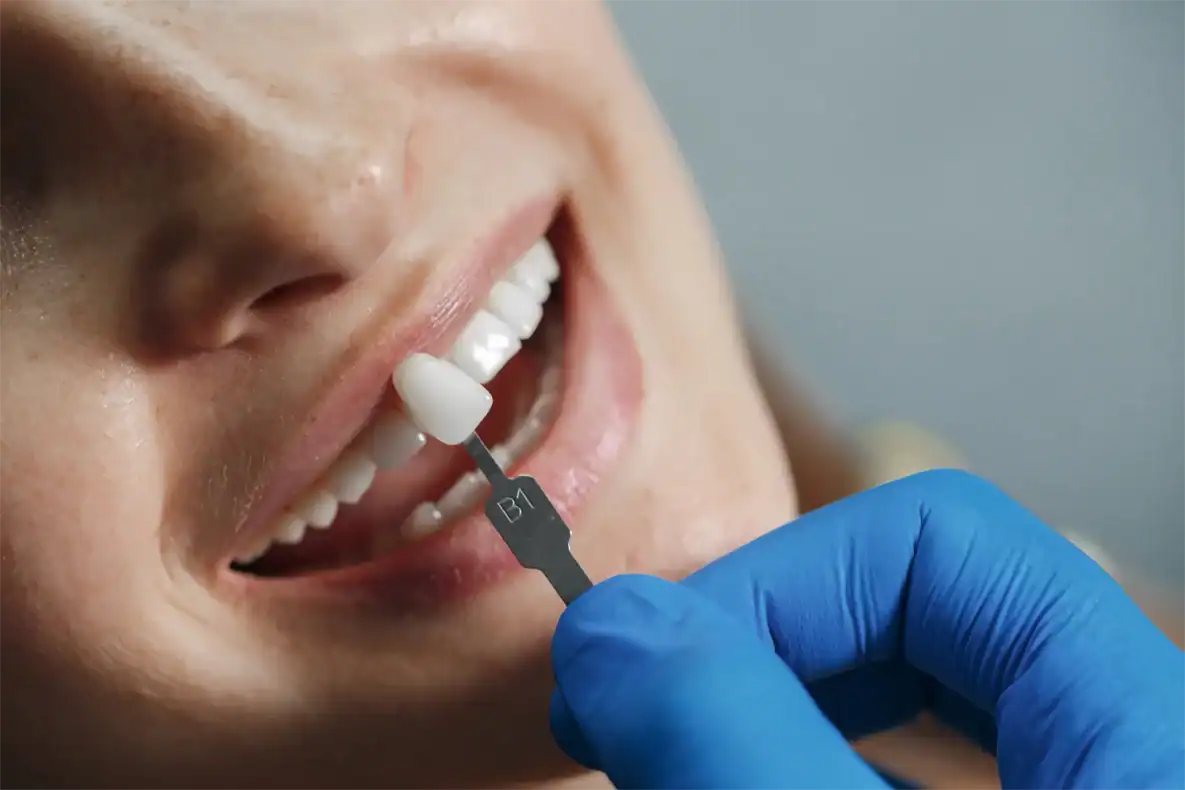 KLT dental veneers